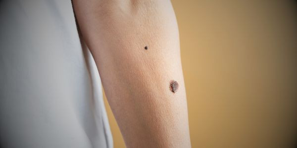 Moles in Astrology